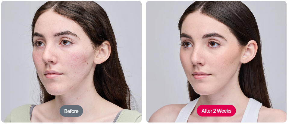 ReGlow - LED Light Therapy Mask