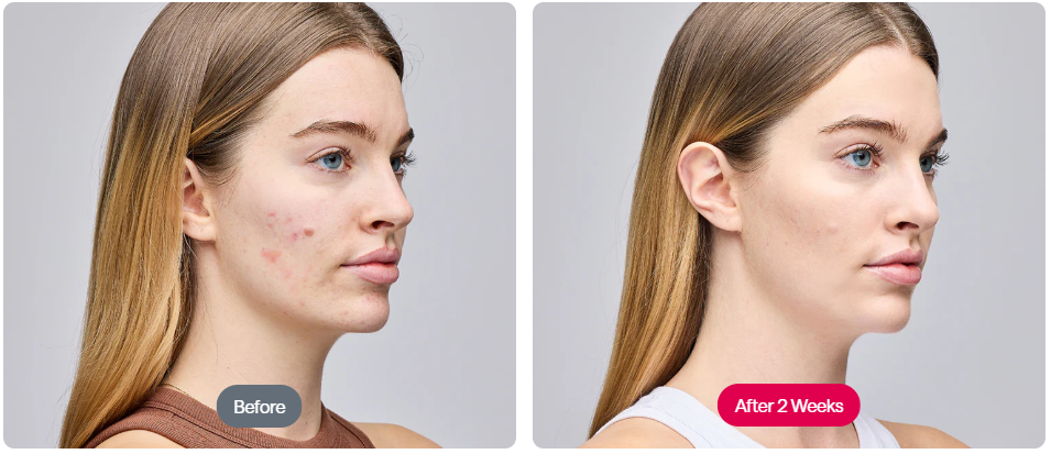 ReGlow - LED Light Therapy Mask